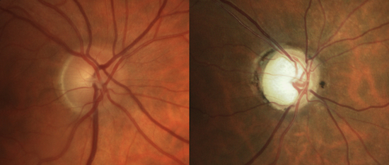 Healthy (left) vs Glaucomatous (right) optic nerves