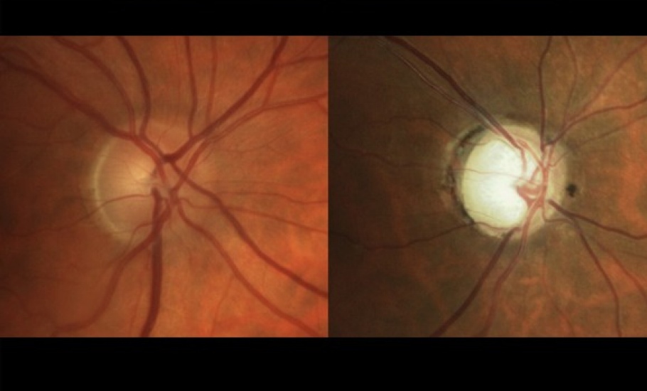 Photographs of a healthy optic nerve (left) and a glaucomatous optic nerve (right)
