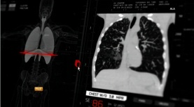 NSAR_News_Lung-Screening NSAR_News_Lung-Screening