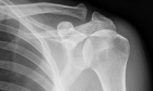 Radiographic analysis of glenoid size and shape after arthroscopic coracoid autograft vs. distal tibial allograft in the treatment of anterior shoulder instability