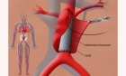 Endovascular management of unruptured intercostal artery aneurysms