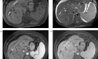 Evaluation of liver MRI examinations with two dosages of gadobenate dimeglumine: a blinded intra‑individual study