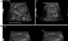 Bilateral renal vein and inferior vena cava thrombosis associated with fetal vascular malperfusion and maternal diabetes