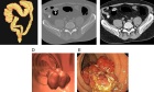 The yield and patient factors associated with CT colonography C‑RADS results in a non‑screening patient population