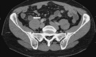 Diagnostic Performance of a Staged Pathway for Imaging Acute Appendicitis in Children