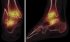 Preliminary Experience With SPECT/CT to Evaluate Periarticular Arthritis Progression and the Relationship With Clinical Outcome Following Ankle Arthrodesis