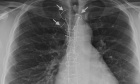 Migrated fractured sternal wire in proximity to the main pulmonary artery: Case report and review