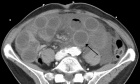 Pearls, Pitfalls, and Conditions that Mimic Mesenteric Ischemia at CT