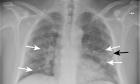 Canadian Society of Thoracic Radiology/ Canadian Association of Radiologists Consensus Statement Regarding Chest Imaging in Suspected and Confirmed COVID‑19