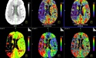 Admission Perfusion CT for Classifying Early In‑Hospital Mortality of Patients With Severe Traumatic Brain Injury: A Pilot Study