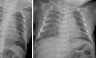 A multi institutional comparison of imaging dose and technique protocols for neonatal chest radiography