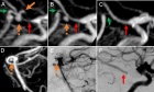 Competitive flow diversion of multiple P1 aneurysms: proposed classification