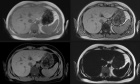 Benign Neoplasms, Mass‐Like Infections, and Pseudotumors That Mimic Hepatic Malignancy at MRI