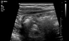 Ultrasound and CT in the Diagnosis of Appendicitis: Accuracy With Consideration of Indeterminate Examinations According to STARD Guidelines