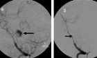 Angiographic results of surgical or endovascular treatment of intracranial aneurysms: a systematic review and inter‑observer reliability study