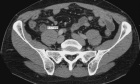 Diagnostic performance and radiation dose of reduced vs. standard scan range abdominopelvic CT for evaluation of appendicitis