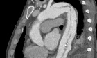 Updates to Reporting Computed Tomography Angiograms of Acute Aortic Syndromes