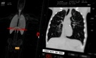 Nova Scotia’s Lung Screening Program expanding to Cape Breton, eastern mainland