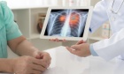 How environmental exposures are reshaping lung cancer and redefining early detection