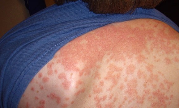 Health Canada approves psoriasis treatment discovered